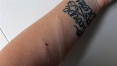 Woman Posts Scars From Suicide Attempt To Help Troubled Teens