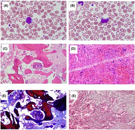 A Case Of A Primary Myelofibrosis With Progression And Related