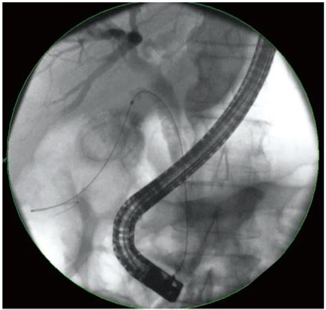 Endoscopic Gallbladder Drainage For Acute Cholecystitis