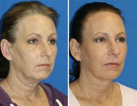 70 year old women look like they re 40 you won t believe their transformation erase wrinkles