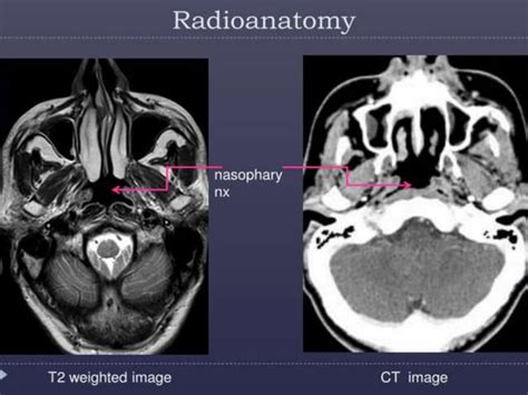 Presentation1pptx Radiological Imaging Of The Nasopharyngeal Diseases