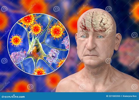 Infectious Etiology Of Dementia Viruses That Affect Neurons Royalty