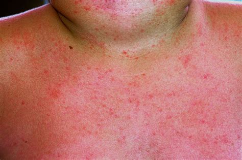 What Is A Heat Rash Symptoms Causes And Treatment Necps