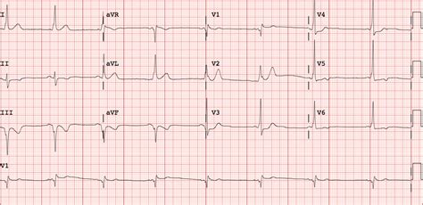 Dr Smiths Ecg Blog Wpw Mimicking And Obscuring Acute Mi