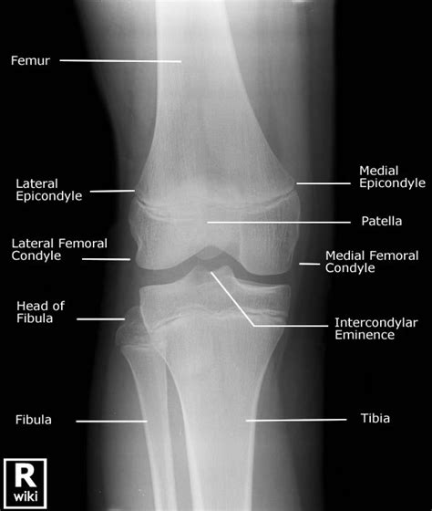 Normal Knee X Rays Bone And Spine