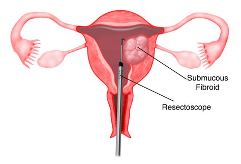 Fibroid adalah ketumbuhan benigna dinding rahim. Bab 2 - Fibroid Rahim - Melaka Fertility - Selva's ...