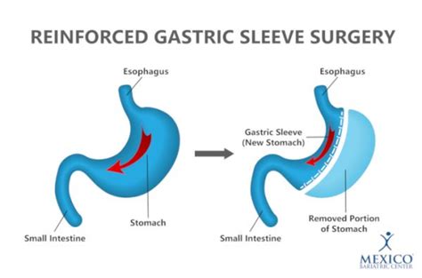 Reinforced Gastric Sleeve Surgery Mexico Bariatric Center