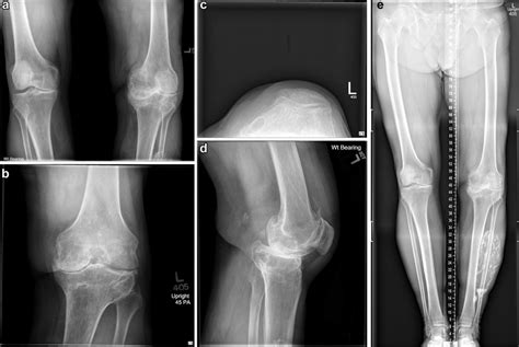 Preoperative Left Knee Radiographs Bilateral Anteroposterior A Left