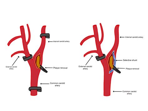 Aorta Cross Clamping A Dangerous Procedure Steve Gallik