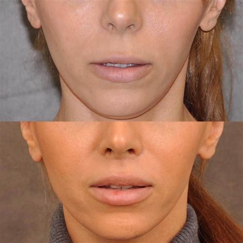 beverly hills lip lift dentistry west hollywood lip lifts dentist