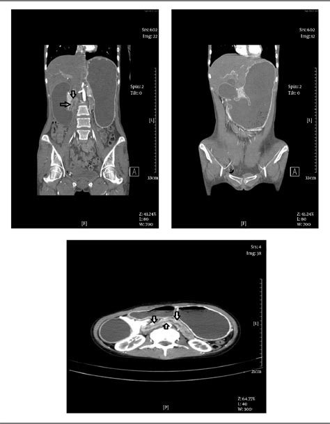 Figure 1 From Obstructive Duodenal Lymphoma A Case Report Semantic