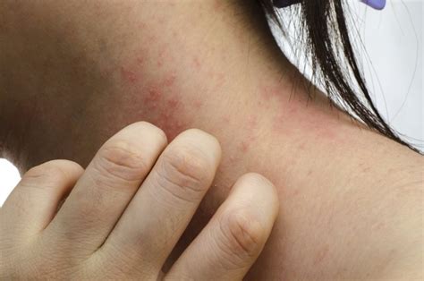 Home Remedies To Stop An Itchy Rash Leaftv