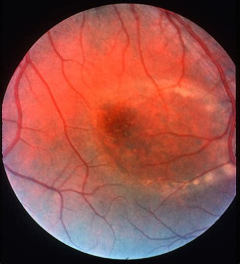 Chronic Central Serous Chorioretinopathy Retina Image Bank