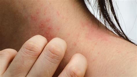 Trigger Factors For Eczema And Itchy Rashes