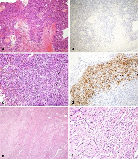 Two Cases Of Perivascular Epithelioid Cell Tumor Of The Uterus