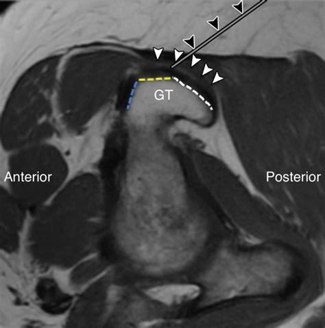 Bursa Hip Mri