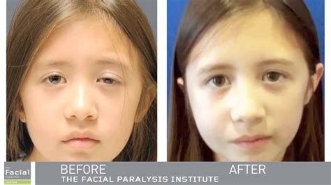Gracilis Free Flap Before And After Facial Paralysis Surgery Youtube