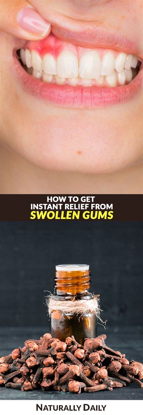 11 Home Remedies For Swollen Gums For Instant Relief Swollen Gums Are