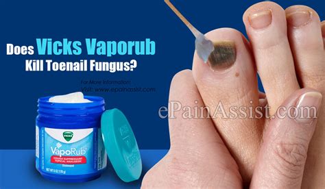 Does Vicks Vaporub Kill Toenail Fungus