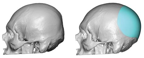 Custom Skull Implant Design For Flat Back Of Head Left Side View Dr