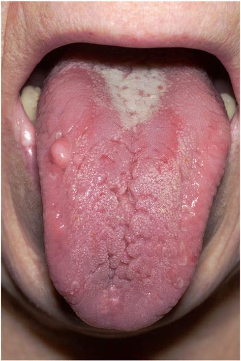 Diseases of the tongue - Clinics in Dermatology