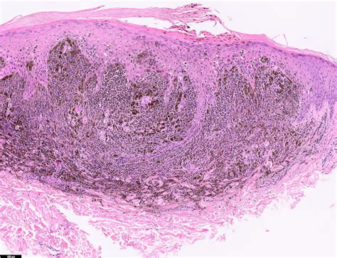 Malignant Melanoma Histology