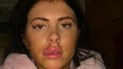 woman feared she d go blind after lip exploded and spread filler infection to eye mirror online