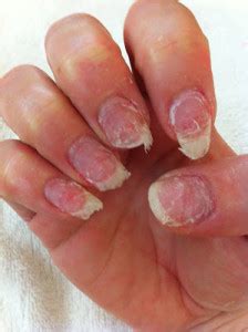 Factors more often associated with malignant melanoma of the nail matrix include new onset after middle age, presence of pigmentation on the dominant thumb or hallux, rapid growth or darkening, bandwidth > 3 mm, associated nail plate dystrophy, or hutchinson sign (extension of hyperpigmentation onto the proximal and/or lateral nail fold). Give Your Nails A Break From Gel Manicures!