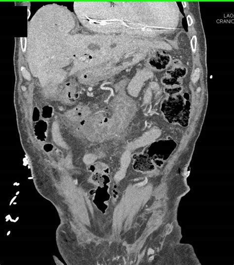 Perforated Stomach With Abscess Stomach Case Studies Ctisus Ct Scanning
