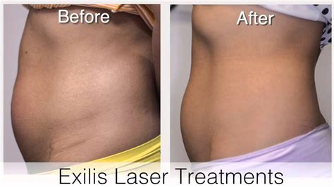 Exilis Body Contouring And Skin Tightening Youtube