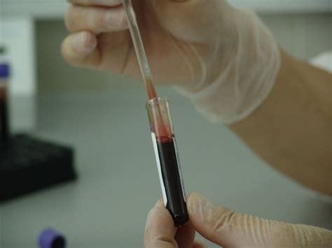 Antistoff i blodprøver og biomarkører BINDEVEVSSYKDOMMER NO