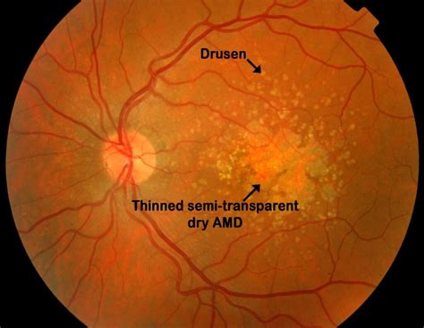 Age Related Changes Drusen And Macular Degeneration Eye Surgery Ltd