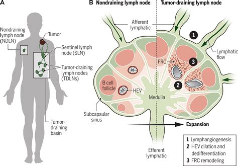 Tumor Draining Lymph Nodes At The Crossroads Of Metastasis And