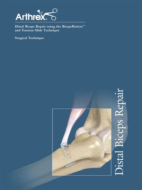 Distal Biceps Repair Using The Bicepsbutton™ And Tension Slide