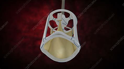 Artificial Aortic Valve Replacement Stock Video Clip K0035494