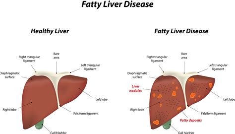 Acute Fatty Liver Disease Of Pregnancy The Pulse