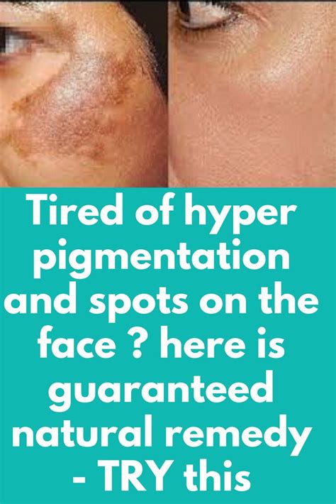 Tired Of Hyper Pigmentation And Spots On The Face Here Is Guaranteed
