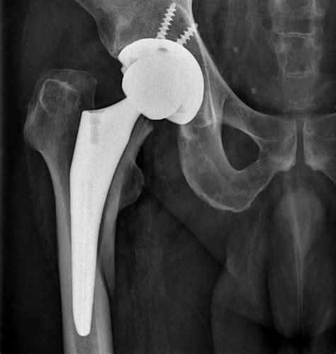 Orthodx Fall After Total Hip Arthroplasty Clinical Advisor