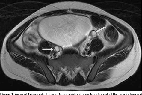 It's a congenital disorder in women, in which the embryonic müller conducts don't develop, and as a consequence the woman suffers from primary amenorrhea and absence of uterus and. Figure 3 from MRI in the diagnosis of Mayer-Rokitansky ...