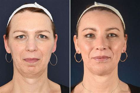 Contents And Recovery Of Lip Lift Surgery