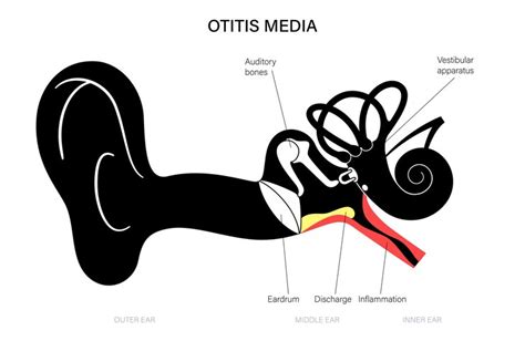 Premium Vector Otitis Media Disease