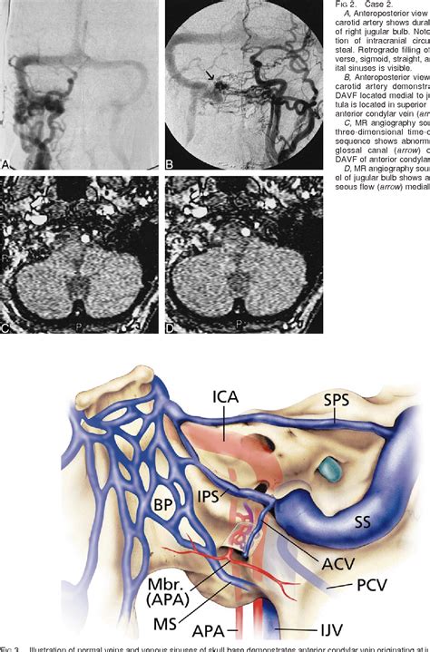 Figure 2 From Three Cases Of Dural Arteriovenous Fistula Of The