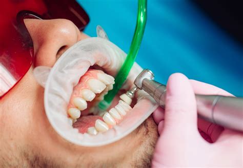 Know More About Dental Deep Cleaning Technique Teeth Scaling Dentaldost