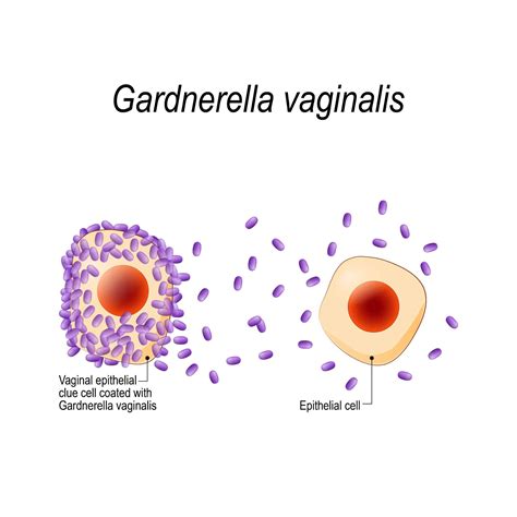 Gardnerella Vaginalis Infection Causes And Treatments Archyde
