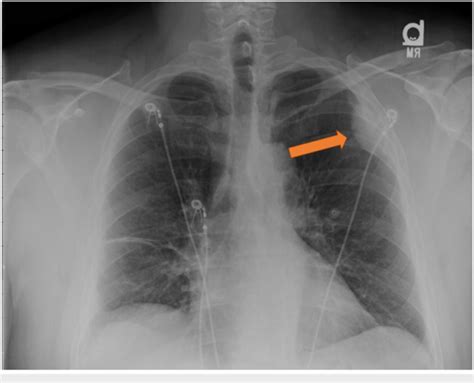 Chest X Ray Posteroanterior View Chest X Ray Posteroanterior View