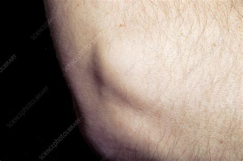 Tennis Elbow Swelling Stock Image C0117430 Science Photo Library