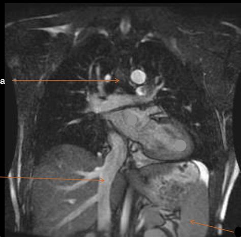 Thorax Coronal Diagram Quizlet