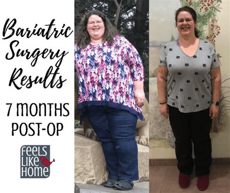Bariatric Gastric Sleeve Surgery Update And Results 7 Months Post Op