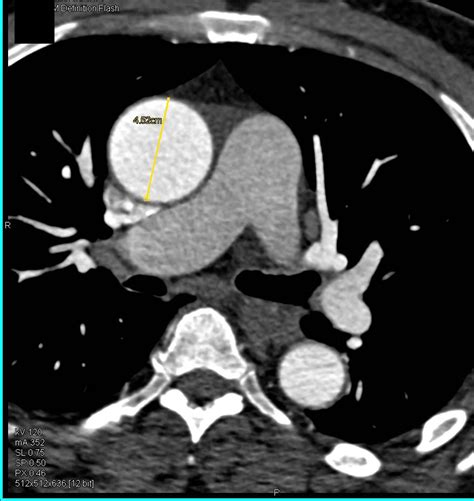 Dilated Aortic Root Vascular Case Studies Ctisus Ct Scanning