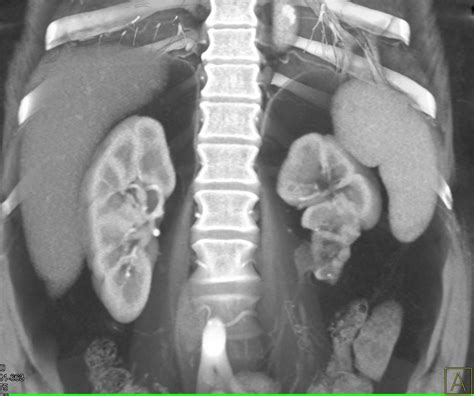 Duplicated Collecting System Left Kidney With Scarring Of The Lower